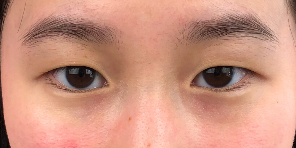 Double Eyelid Surgery in Gurugram