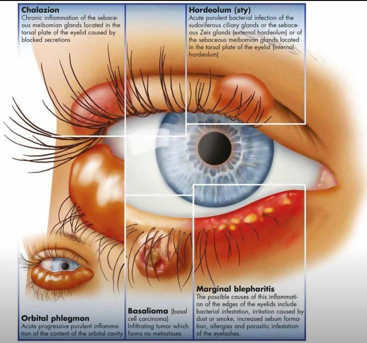 Eyelid Lumps and Bumps Treatment in Gurugram