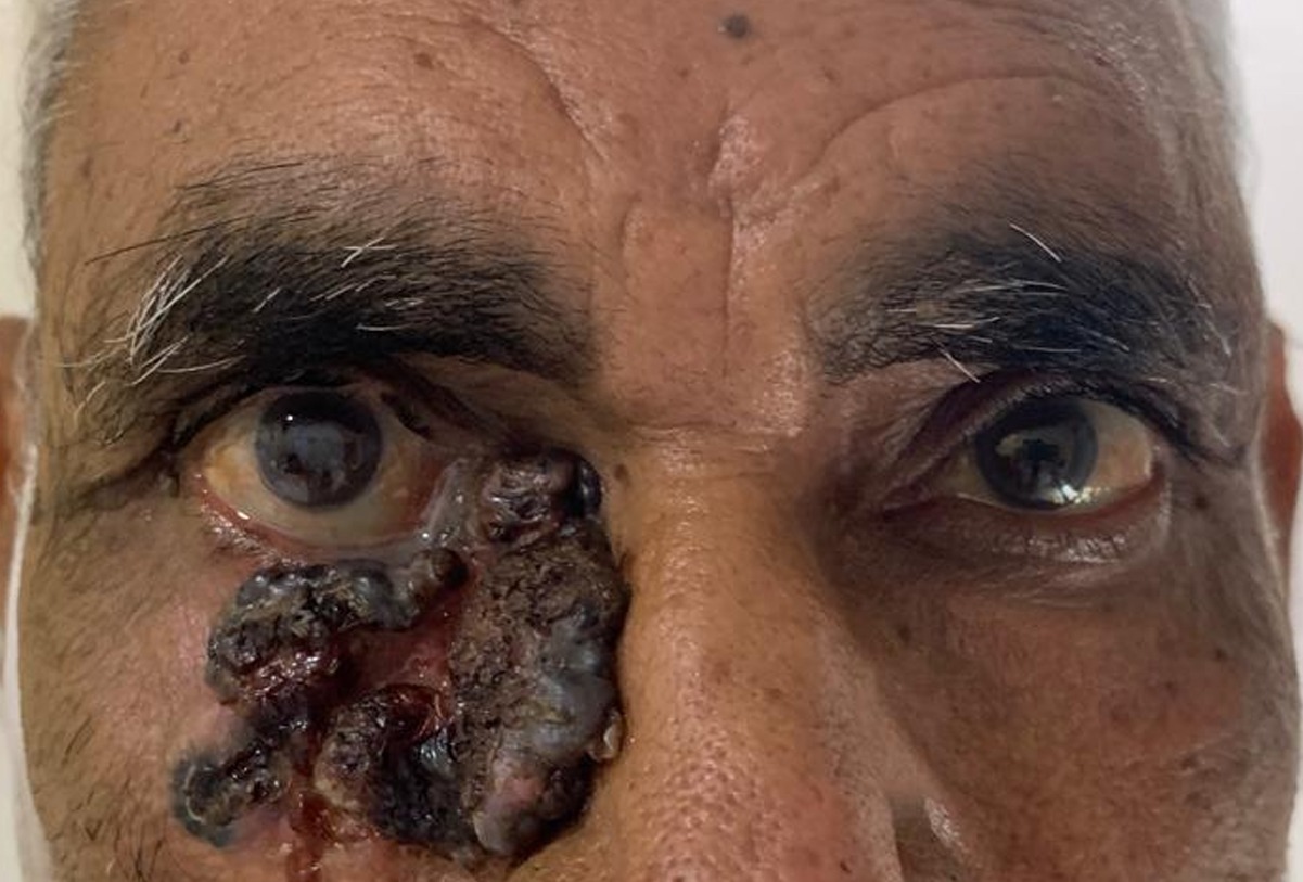 Eyelid Tumor Surgery in Gurugram