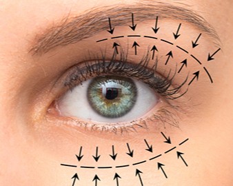 Eyelid Lift