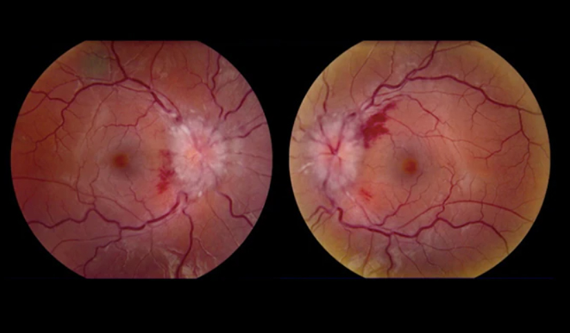 Idiopathic Intracranial Hypertension(IIH) Treatment in Gurugram