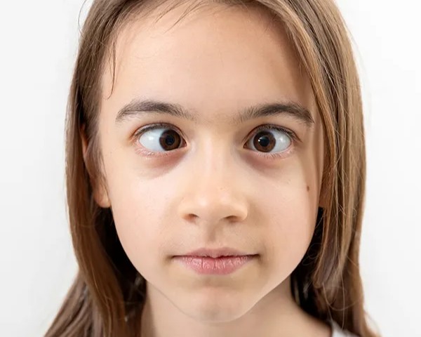 Eye Squint Treatment in Gurugram