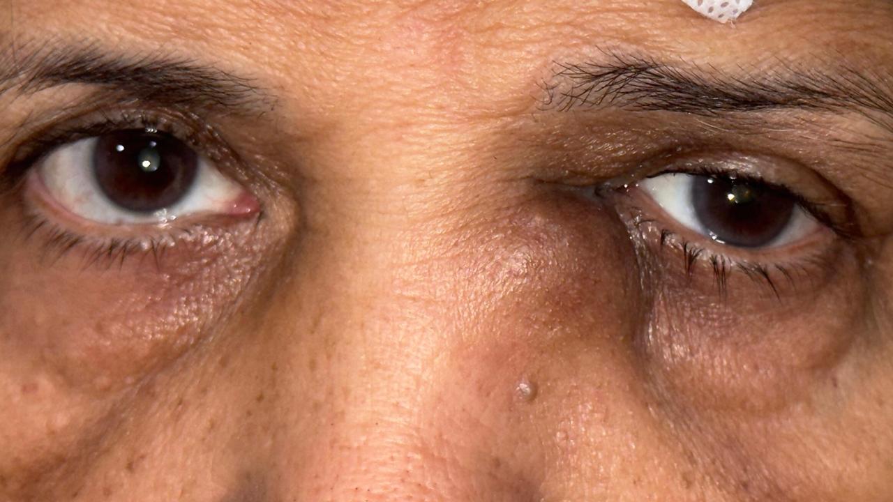 Tear Duct Infection Treatment in Gurugram