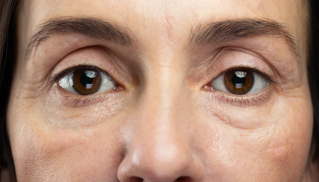 Under Eye Bags Treatment in Gurugram