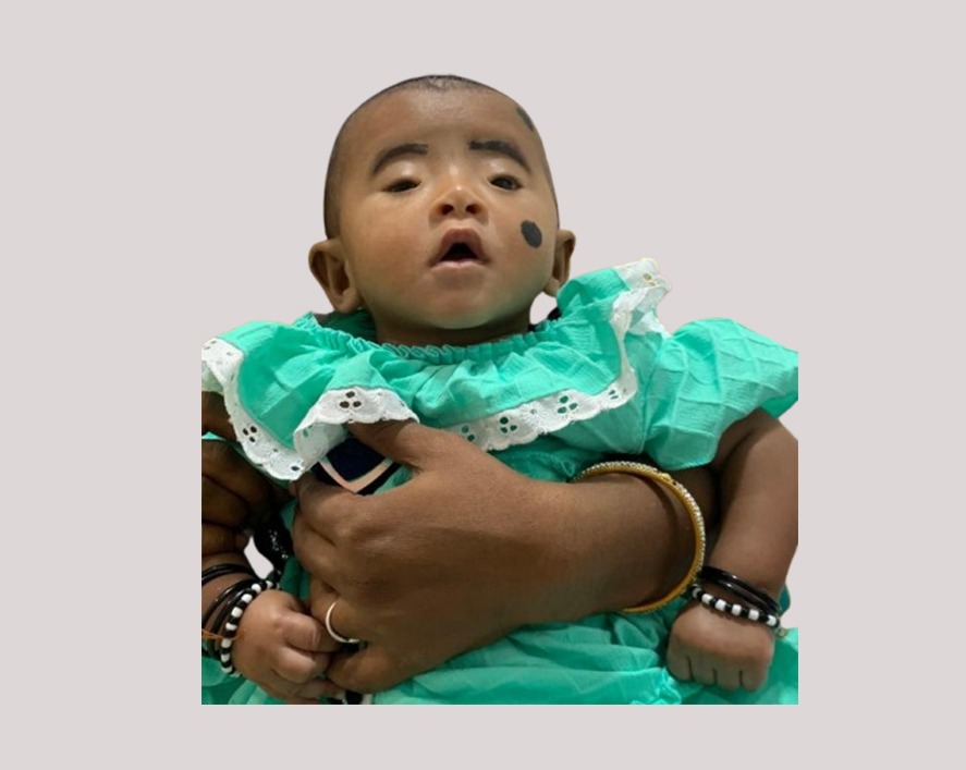 Eye Birth Defects Treatment in Gurugram