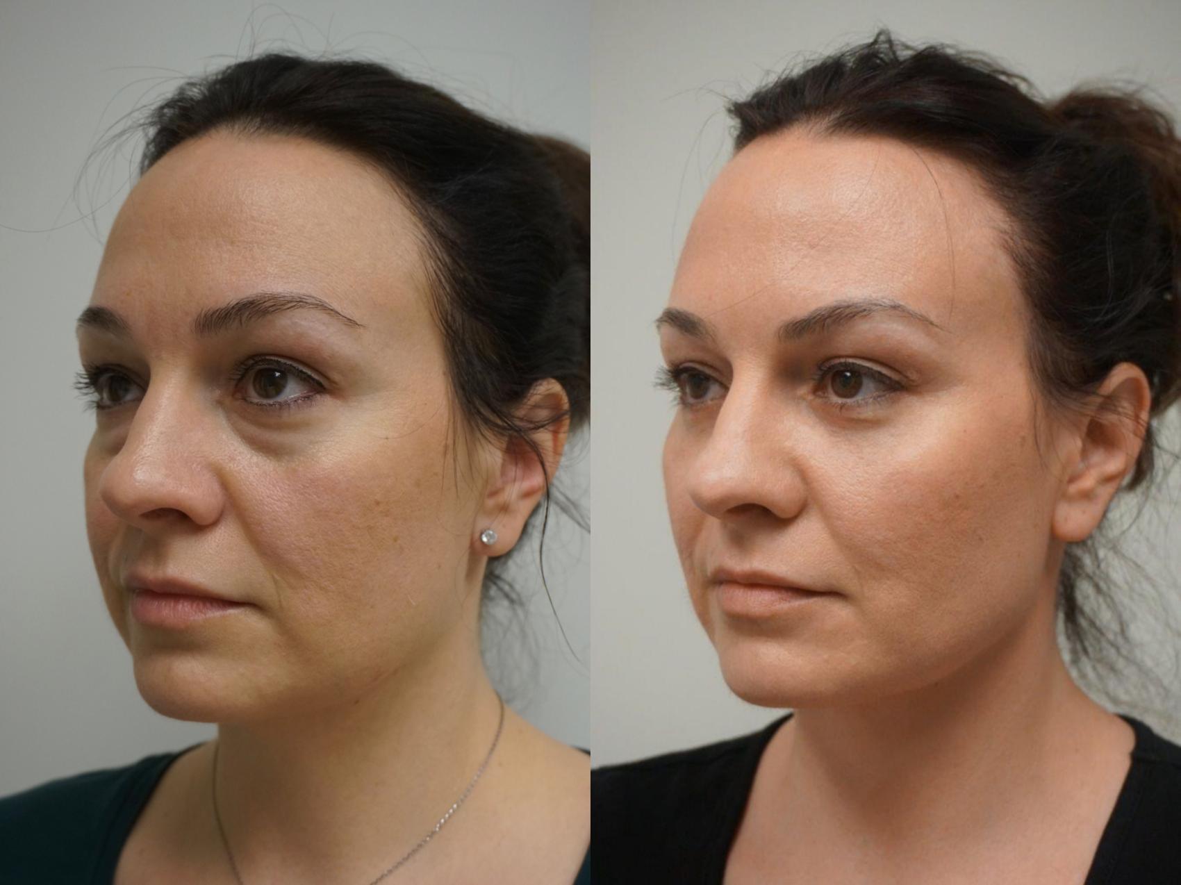 Eyelid Blepharoplasty Treatment in Gurugram