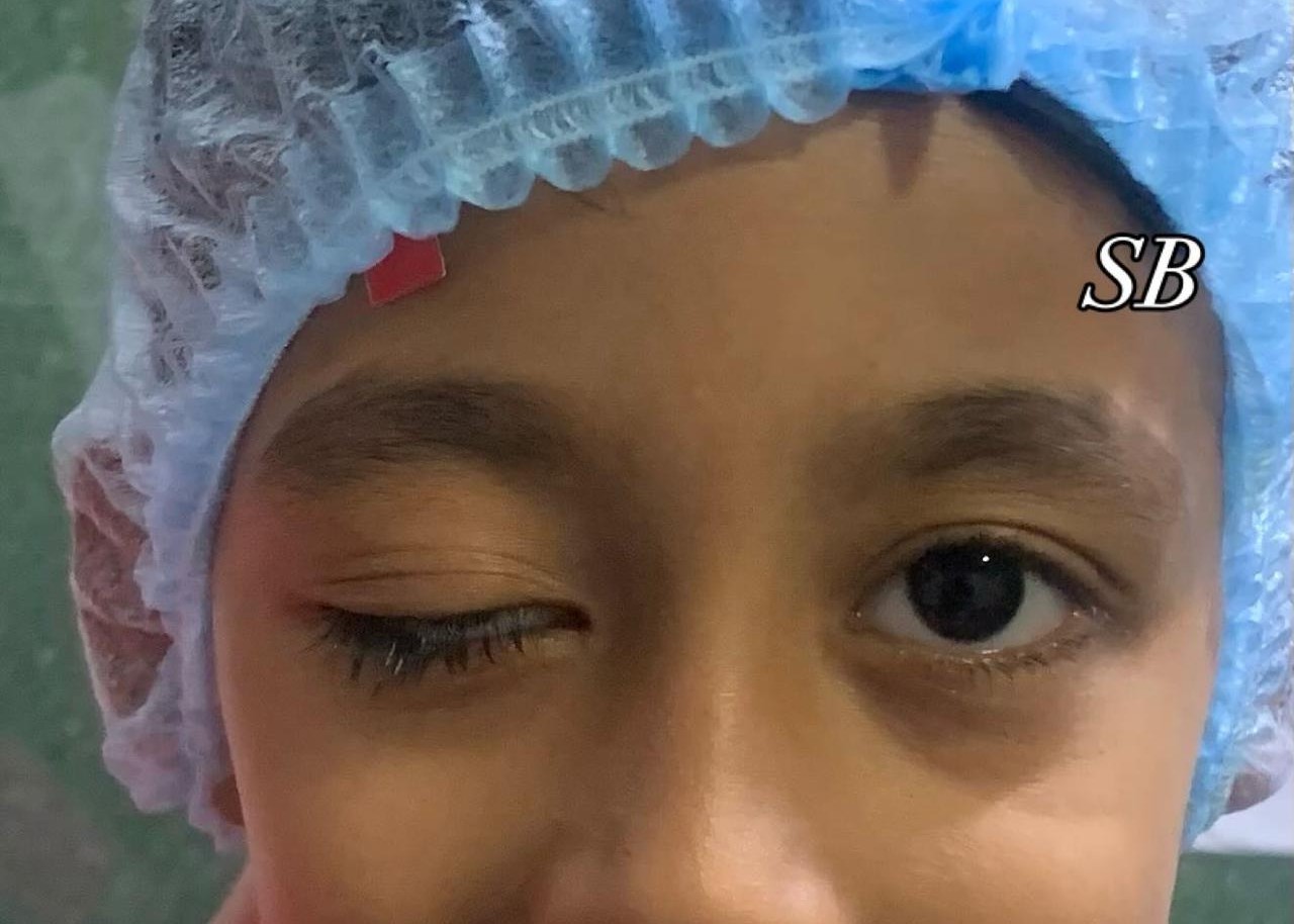 Ptosis surgery in Gurgaon