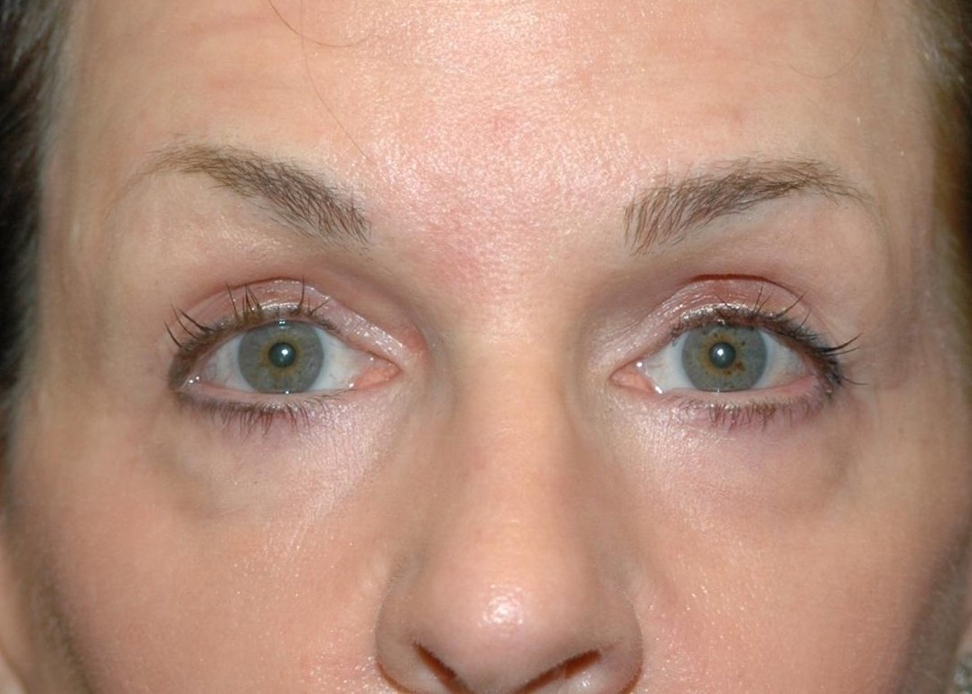 Eyelid Retraction Treatment in Gurugram