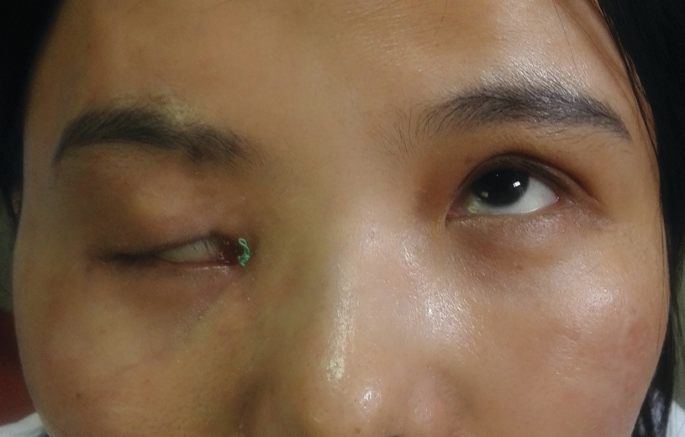 Eyelid Trauma Reconstruction Surgery in Gurugram