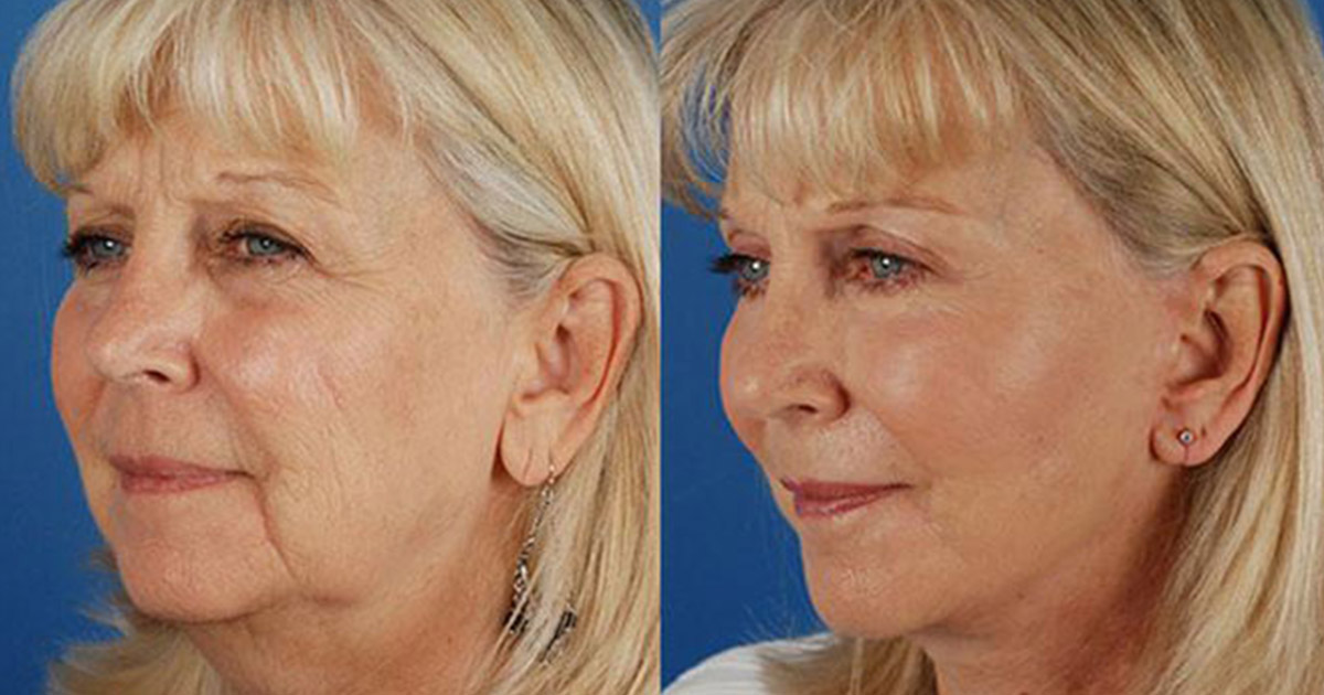 Mid Face Lift Surgery in Gurugram